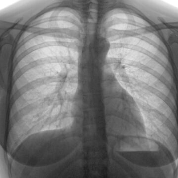Stop TB aprueba USD 6,14 millones para once proyectos