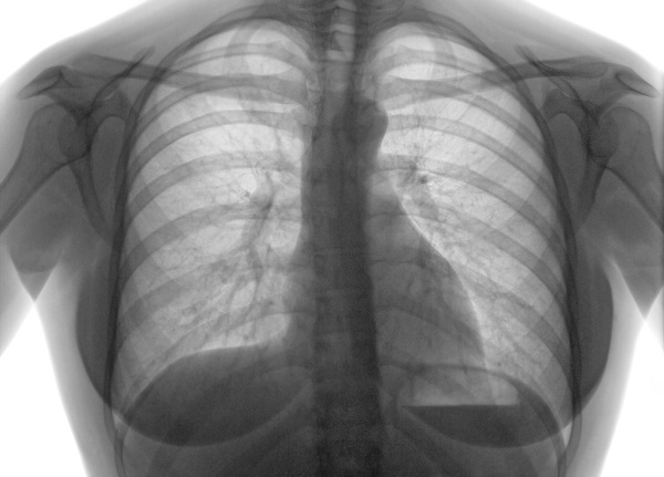 Roentgenogram Stop TB aprueba USD 6,14 millones para once proyectos
